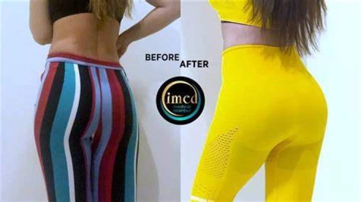 Celebrities And The Brazilian Butt Lift