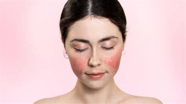 Does A Butterfly Rash Always Mean You Have Lupus?