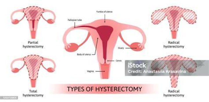 What is a hysterectomy?